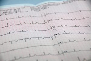 5-Lead ECG