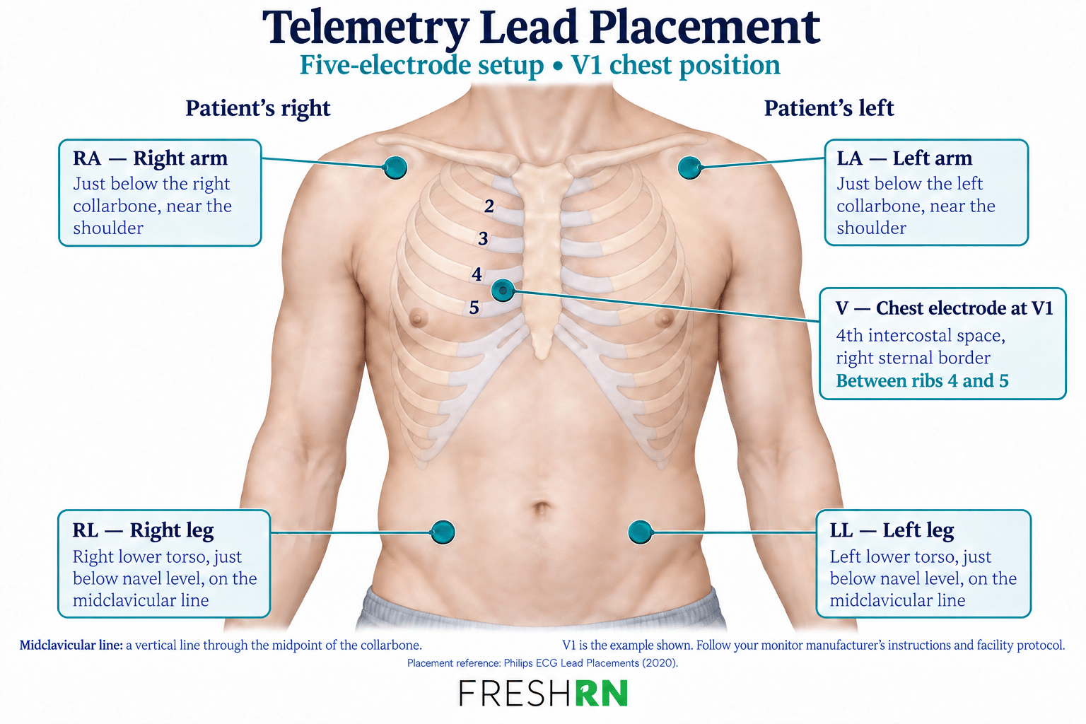 Telemetry Lead Placement and Monitoring Basics for Nurses 1 Five-electrode telemetry lead placement using V1 for the chest electrode. Right and left refer to the patient’s perspective.